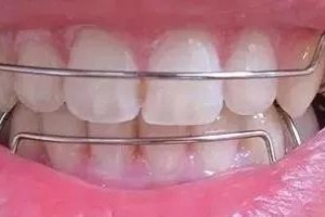 牙齿纠正有必要戴坚持器吗 牙齿纠正有必要戴坚持器吗