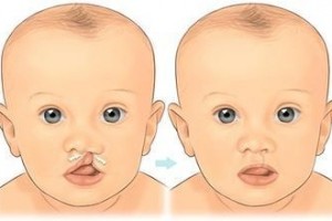 全国2%婴幼儿竟然有或许患上这个病 全国2%婴幼儿竟然有或许患上这个病