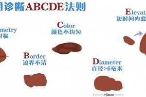 认为黑痣却是恶性黑色素瘤这种疾病常常被人忽视耽搁医治 认为黑痣却是恶性黑色素瘤这种疾病常常被人忽视耽搁医治