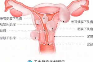 子宫简单长肌瘤的女性都有1个共性体检发现异常别粗心 子宫简单长肌瘤的女性都有1个共性体检发现异常别粗心