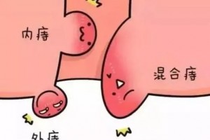 有痔疮不想开刀我院消化内科快速处理你的难题