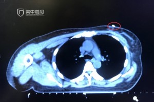 乳腺癌保乳术后怎么只留美丽不留危险 乳腺癌保乳术后怎么只留美丽不留危险