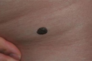 黑色素痣的医治办法有哪些点痣后必需要分外留意哪些问题 黑色素痣的医治办法有哪些点痣后必需要分外留意哪些问题