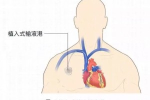 【科普展播】输液港——肿瘤患者的避风港