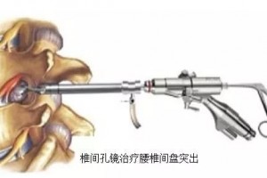 腰椎间盘突出怎么办专家说你能够这么做……