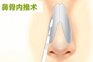 宠爱梅医师科普时刻宽鼻纠正 宠爱梅医师科普时刻宽鼻纠正
