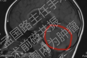 什么是术后沉默怎么防止——谈髓母细胞瘤手术 什么是术后沉默怎么防止——谈髓母细胞瘤手术