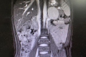 【首儿战疫】5岁男孩头疼多汗医院确诊竟是肿瘤 【首儿战疫】5岁男孩头疼多汗医院确诊竟是肿瘤