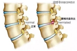 腰椎间盘突出不必慌只需做到这一点突出了也不腰疼 腰椎间盘突出不必慌只需做到这一点突出了也不腰疼