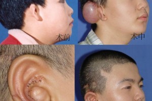 关于小耳变形整形修正医师手术常遇到的耳再造问题调集（二）