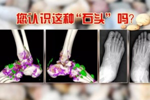化痛风降尿酸这种溶解痛躲不开太多人因而抛弃医治很可惜 化痛风降尿酸这种溶解痛躲不开太多人因而抛弃医治很可惜