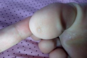 脚底上长了鸡眼怎么办假如不论会自愈吗告知你靠谱方法