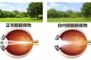 双眼晶状体也随之变得污浊于是就呈现了老年人常见的白内障自查很要害 双眼晶状体也随之变得污浊于是就呈现了老年人常见的白内障自查很要害
